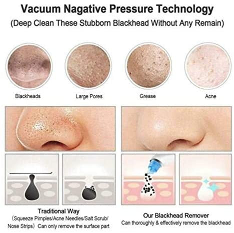 Blackhead Remover